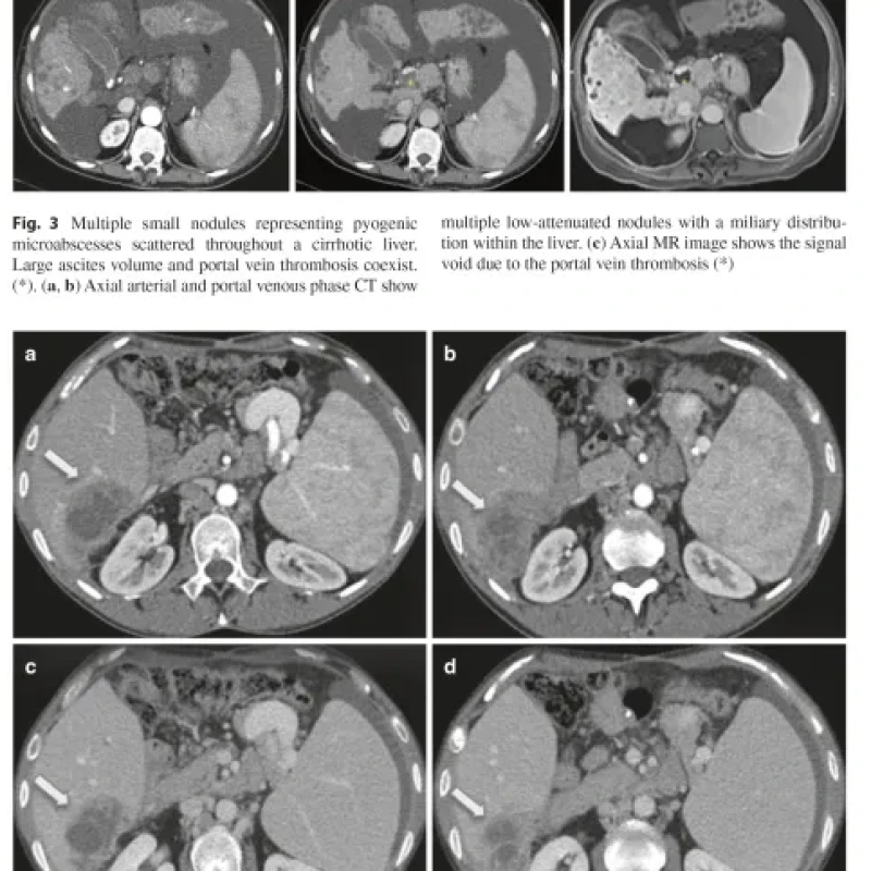 Sách Imaging of the Liver and Intra-hepatic Biliary Tract Volume 2
