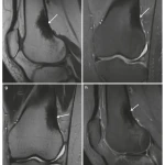Sách Oncologic Imaging Bone Tumors
