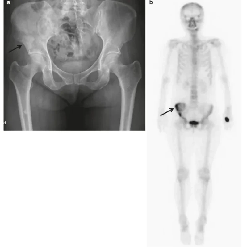 Sách Oncologic Imaging Bone Tumors